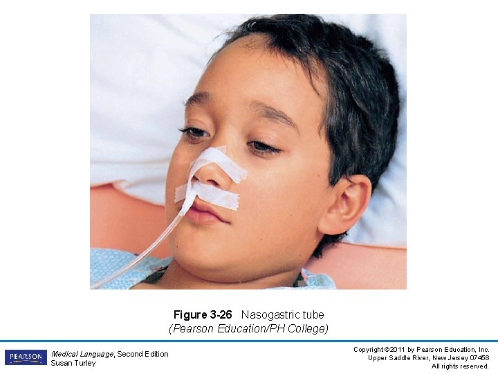 Figure 3 -26 Nasogastric tube (Pearson Education/PH College) Medical Language, Second Edition Susan Turley