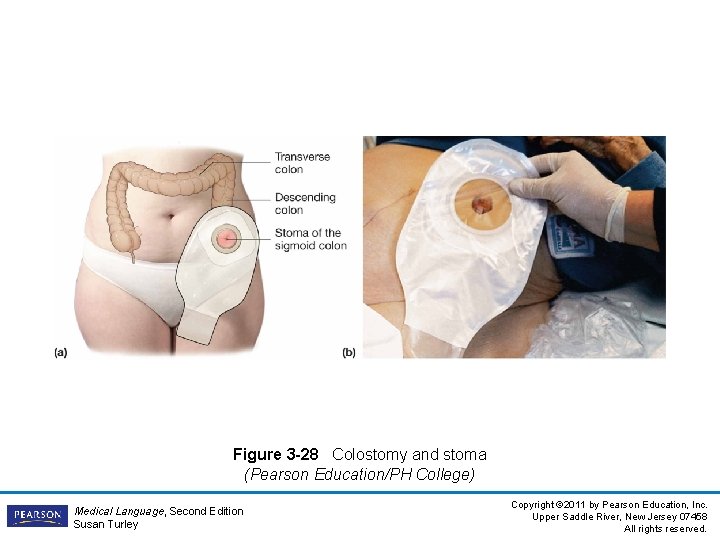 Figure 3 -28 Colostomy and stoma (Pearson Education/PH College) Medical Language, Second Edition Susan