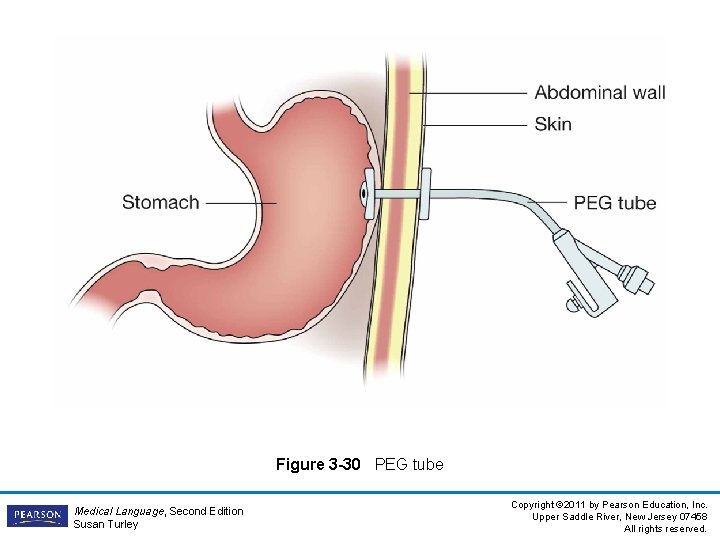 Figure 3 -30 PEG tube Medical Language, Second Edition Susan Turley Copyright © 2011