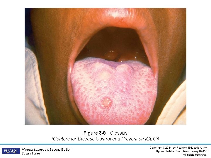 Figure 3 -8 Glossitis (Centers for Disease Control and Prevention [CDC]) Medical Language, Second