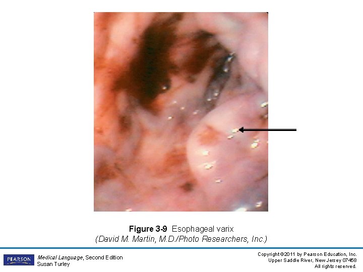 Figure 3 -9 Esophageal varix (David M. Martin, M. D. /Photo Researchers, Inc. )