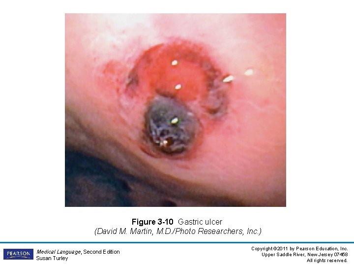 Figure 3 -10 Gastric ulcer (David M. Martin, M. D. /Photo Researchers, Inc. )