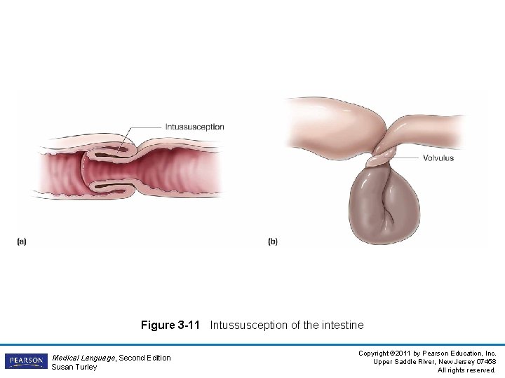 Figure 3 -11 Intussusception of the intestine Medical Language, Second Edition Susan Turley Copyright