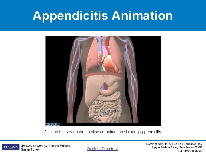 Appendicitis Animation Click on the screenshot to view an animation showing appendicitis. Medical Language,