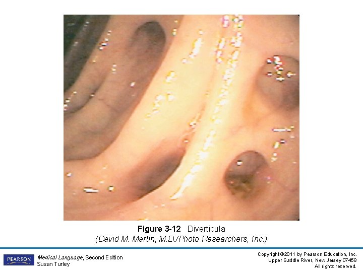 Figure 3 -12 Diverticula (David M. Martin, M. D. /Photo Researchers, Inc. ) Medical