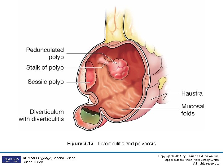 Figure 3 -13 Diverticulitis and polyposis Medical Language, Second Edition Susan Turley Copyright ©