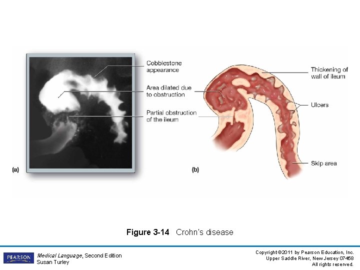 Figure 3 -14 Crohn’s disease Medical Language, Second Edition Susan Turley Copyright © 2011