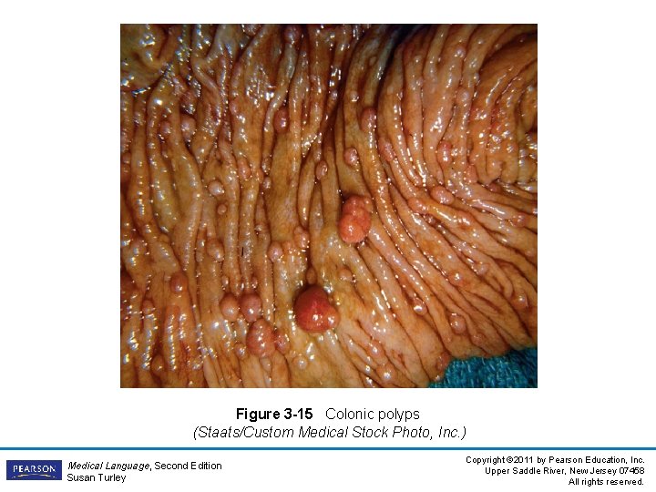 Figure 3 -15 Colonic polyps (Staats/Custom Medical Stock Photo, Inc. ) Medical Language, Second