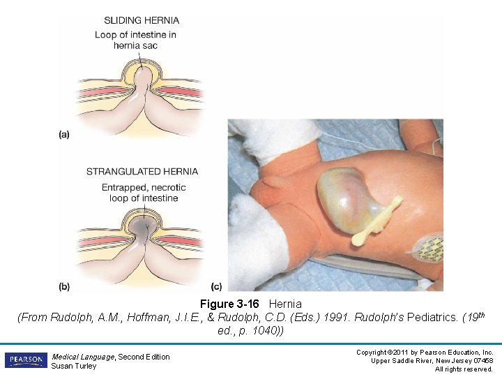 Figure 3 -16 Hernia (From Rudolph, A. M. , Hoffman, J. I. E. ,