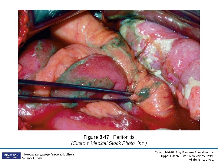 Figure 3 -17 Peritonitis (Custom Medical Stock Photo, Inc. ) Medical Language, Second Edition