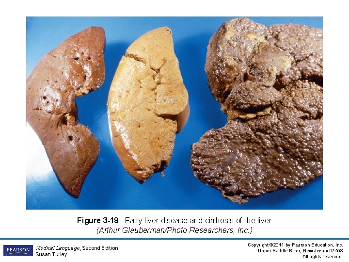 Figure 3 -18 Fatty liver disease and cirrhosis of the liver (Arthur Glauberman/Photo Researchers,