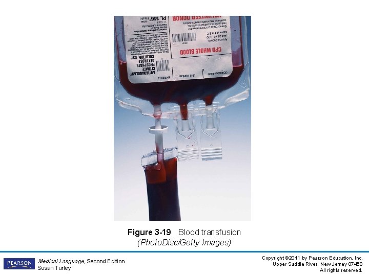 Figure 3 -19 Blood transfusion (Photo. Disc/Getty Images) Medical Language, Second Edition Susan Turley