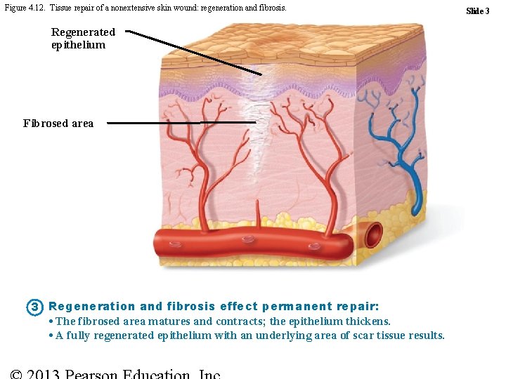 Figure 4. 12. Tissue repair of a nonextensive skin wound: regeneration and fibrosis. Regenerated