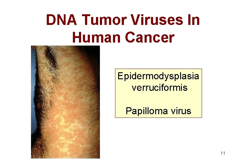 DNA Tumor Viruses In Human Cancer Epidermodysplasia verruciformis Papilloma virus 11 