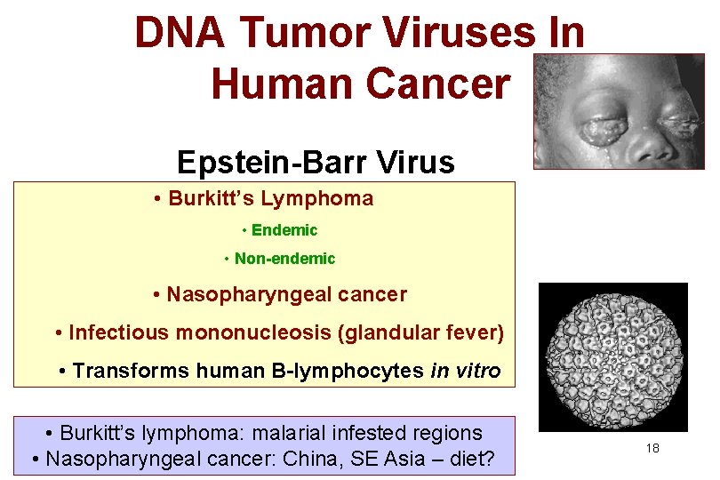 DNA Tumor Viruses In Human Cancer Epstein-Barr Virus • Burkitt’s Lymphoma • Endemic •