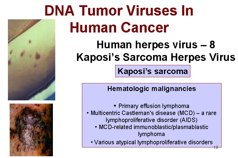 DNA Tumor Viruses In Human Cancer Human herpes virus – 8 Kaposi’s Sarcoma Herpes