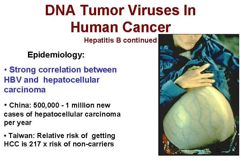 DNA Tumor Viruses In Human Cancer Hepatitis B continued Epidemiology: • Strong correlation between
