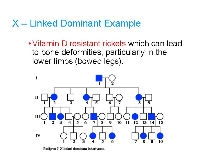 X – Linked Dominant Example • Vitamin D resistant rickets which can lead to