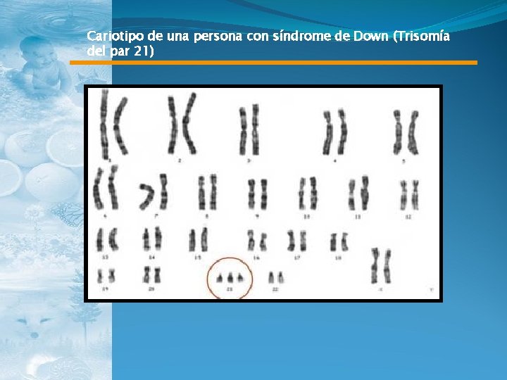 Cariotipo de una persona con síndrome de Down (Trisomía del par 21) 