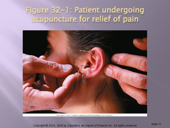 Figure 32 -1: Patient undergoing acupuncture for relief of pain Copyright © 2014, 2009