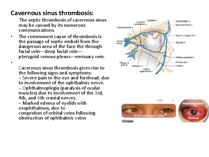 Cavernous sinus thrombosis: • • • The septic thrombosis of cavernous sinus may be