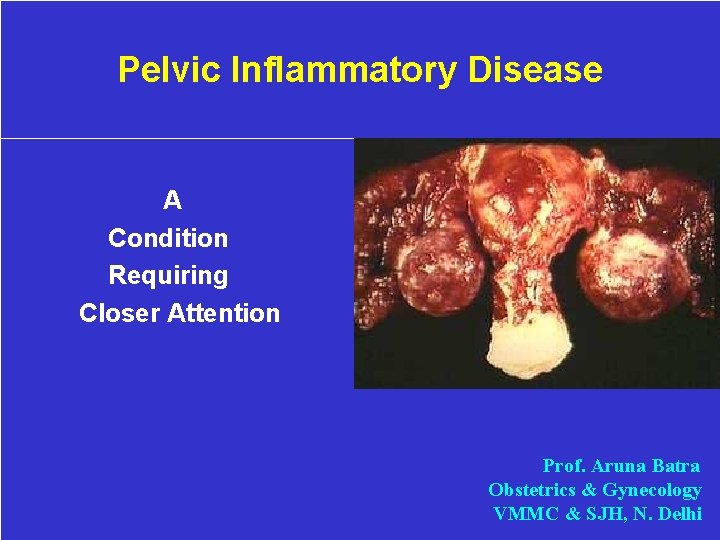 Pelvic Inflammatory Disease A Condition Requiring Closer Attention Prof. Aruna Batra Obstetrics & Gynecology