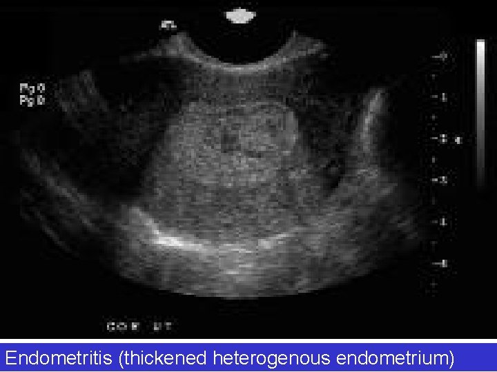 Endometritis (thickened heterogenous endometrium) 