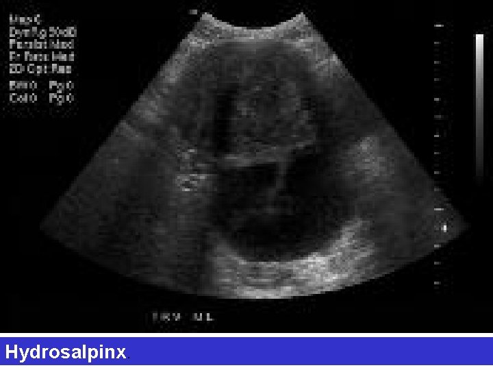 Hydrosalpinx. 