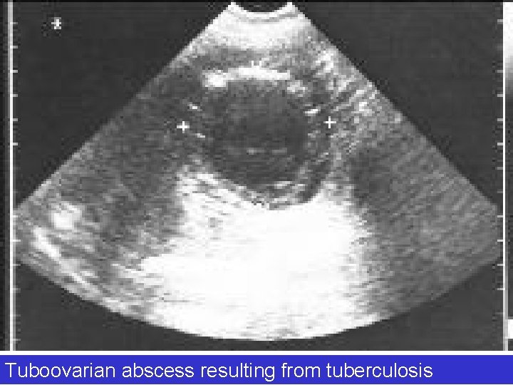 Tuboovarian abscess resulting from tuberculosis 