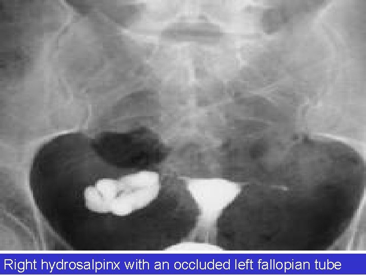 Right hydrosalpinx with an occluded left fallopian tube 