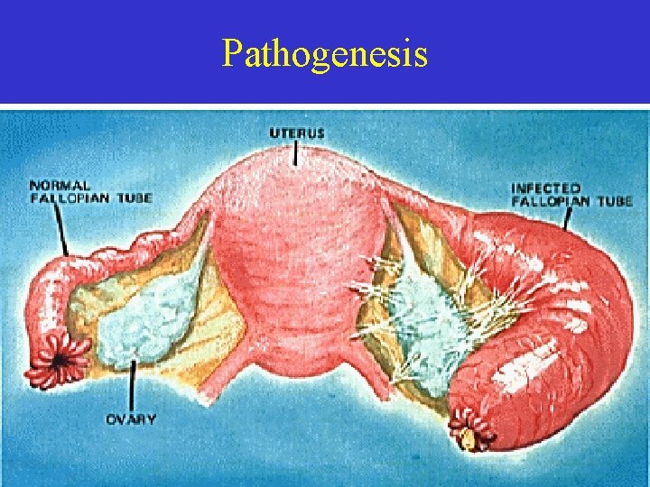 Pathogenesis 