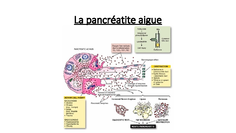 La pancréatite aigue 