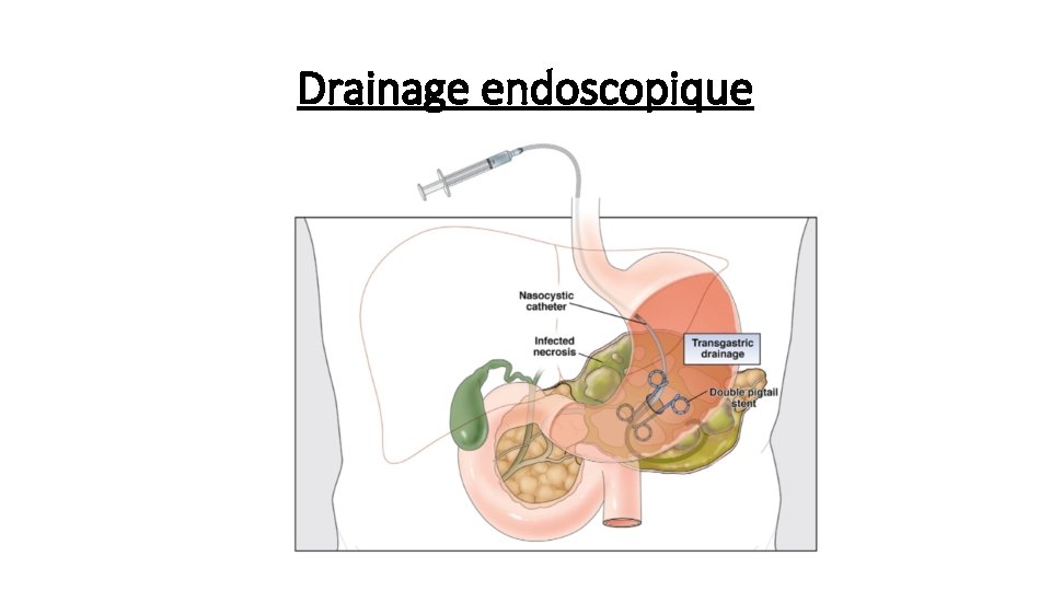Drainage endoscopique 