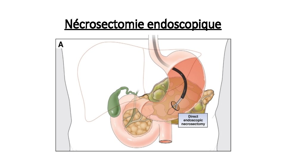 Nécrosectomie endoscopique 