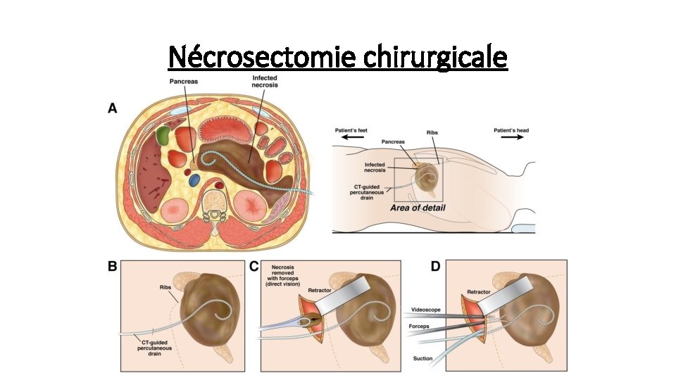 Nécrosectomie chirurgicale 