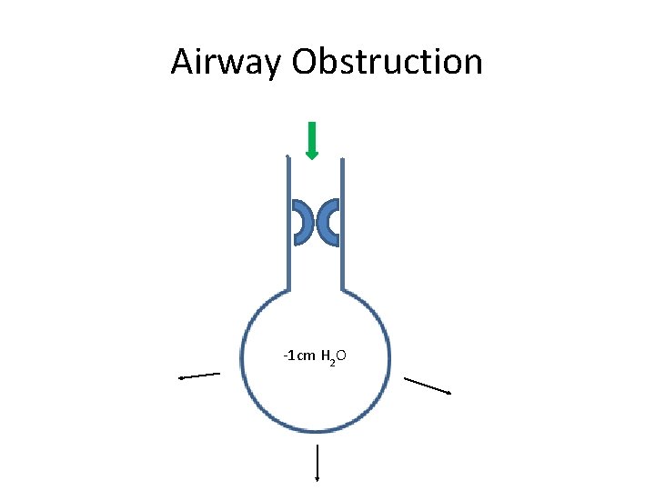 Airway Obstruction -1 cm H 2 O 