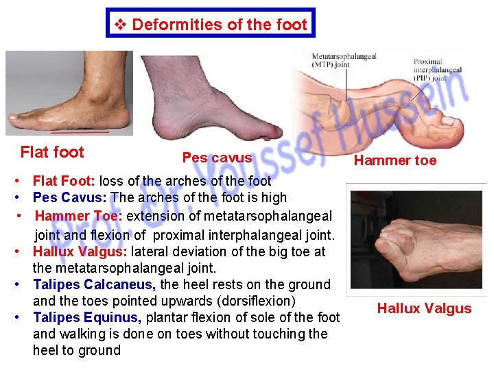 v Deformities of the foot Flat foot Pes cavus • Flat Foot: loss of