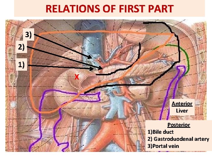 RELATIONS OF FIRST PART 3) 2) 1) X X Anterior Liver Posterior 1)Bile duct