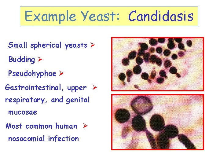 Example Yeast: Candidasis Small spherical yeasts Ø Budding Ø Pseudohyphae Ø Gastrointestinal, upper Ø