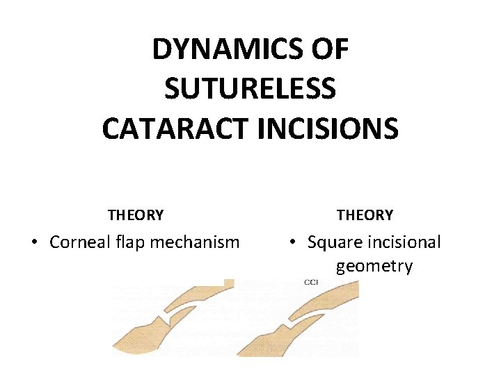 DYNAMICS OF SUTURELESS CATARACT INCISIONS THEORY • Corneal flap mechanism • Square incisional geometry