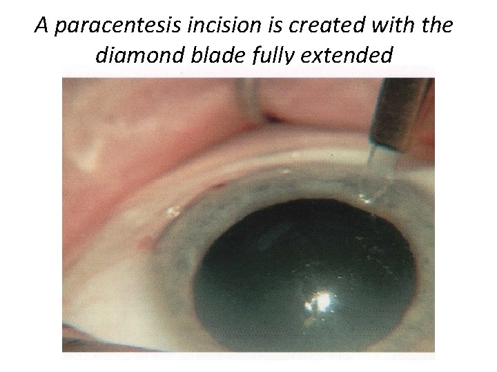 A paracentesis incision is created with the diamond blade fully extended 