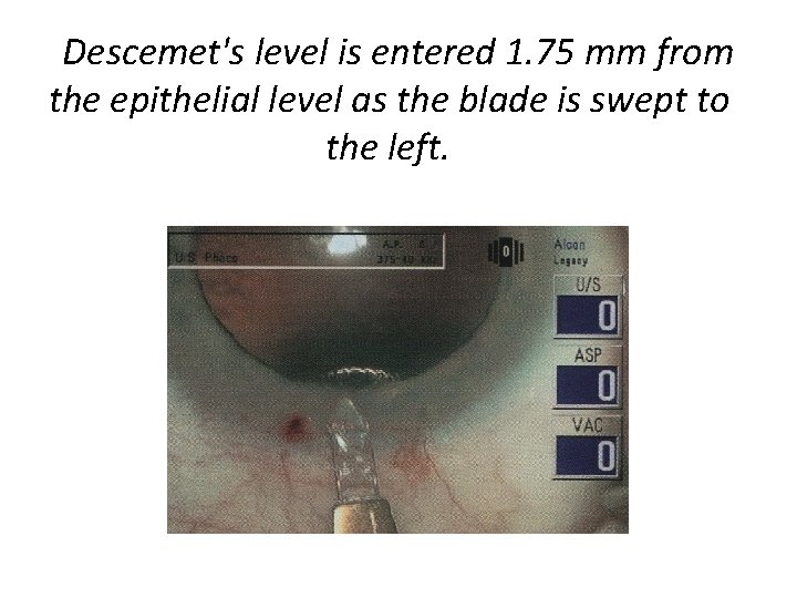 Descemet's level is entered 1. 75 mm from the epithelial level as the blade