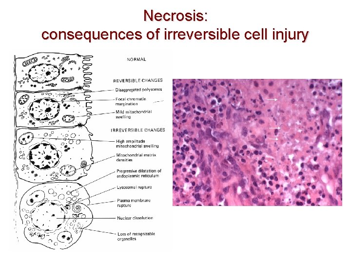 Necrosis: consequences of irreversible cell injury 