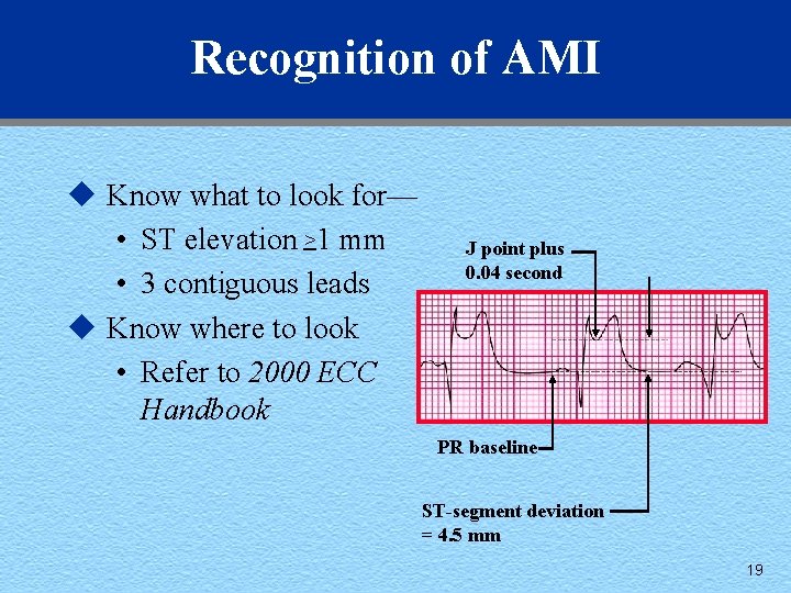 Recognition of AMI u Know what to look for— • ST elevation >1 mm