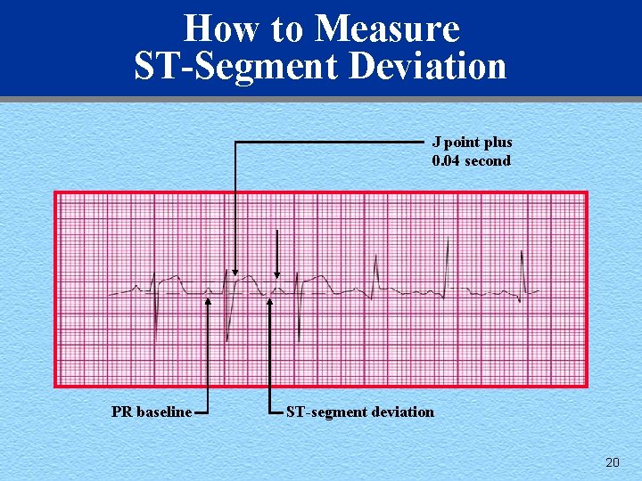 How to Measure ST-Segment Deviation J point plus 0. 04 second PR baseline ST-segment