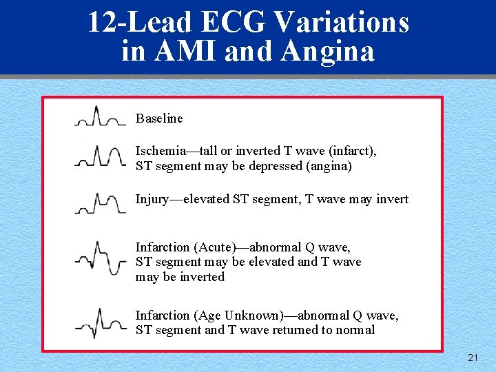 12 -Lead ECG Variations in AMI and Angina Baseline Ischemia—tall or inverted T wave