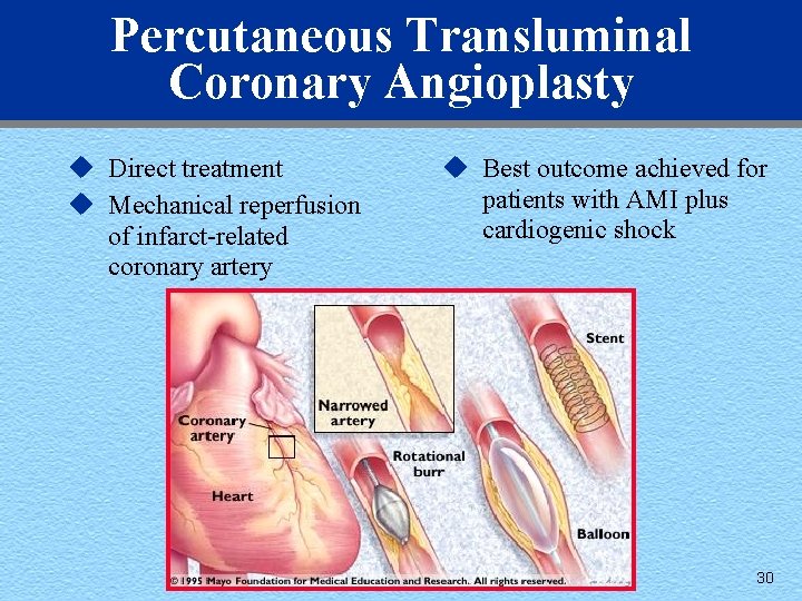 Percutaneous Transluminal Coronary Angioplasty u Direct treatment u Mechanical reperfusion of infarct-related coronary artery