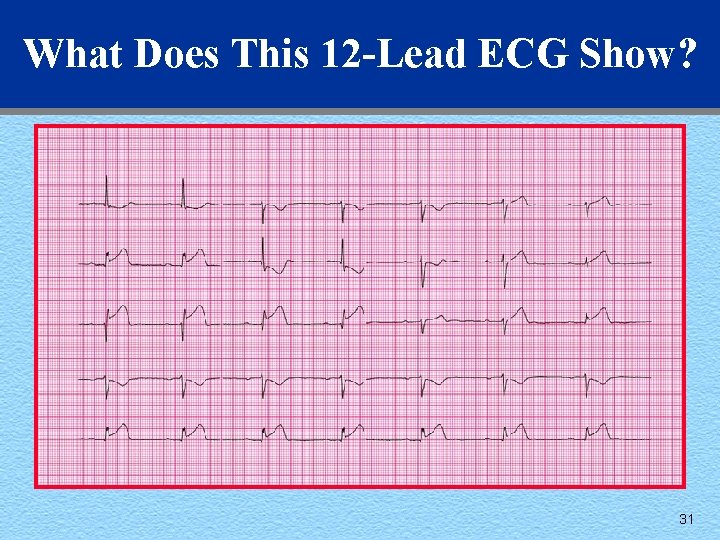 What Does This 12 -Lead ECG Show? 31 