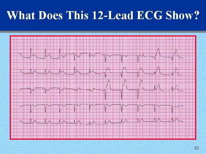 What Does This 12 -Lead ECG Show? 32 