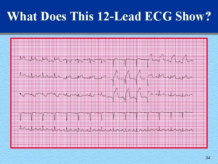 What Does This 12 -Lead ECG Show? 34 
